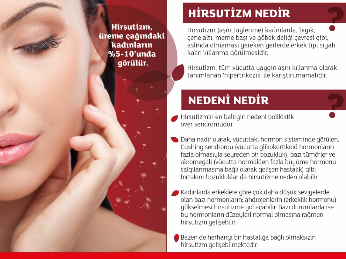 Hirsutizm nedir Hirsutizm nedir